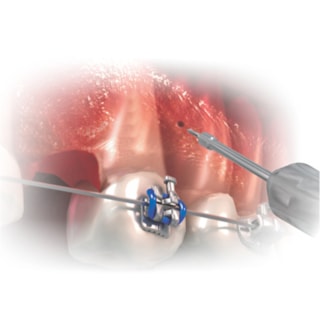 Chave Hexagonal - MORELLI