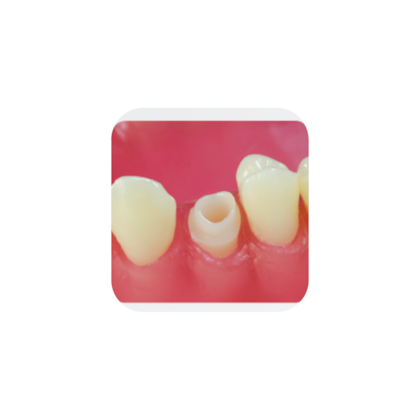 Dente Avulso Diferenciado - Pronew Dente Avulso Diferenciado - Pronew