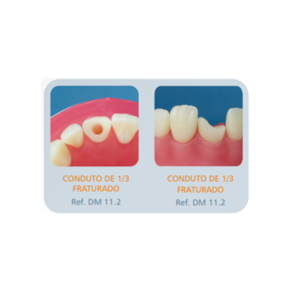 Dente Avulso Diferenciado - Pronew